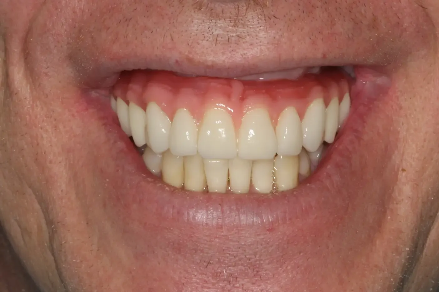 SS After e1755286942727 - Naylor Family Dental