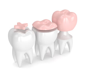 3d render of teeth with different types of filling