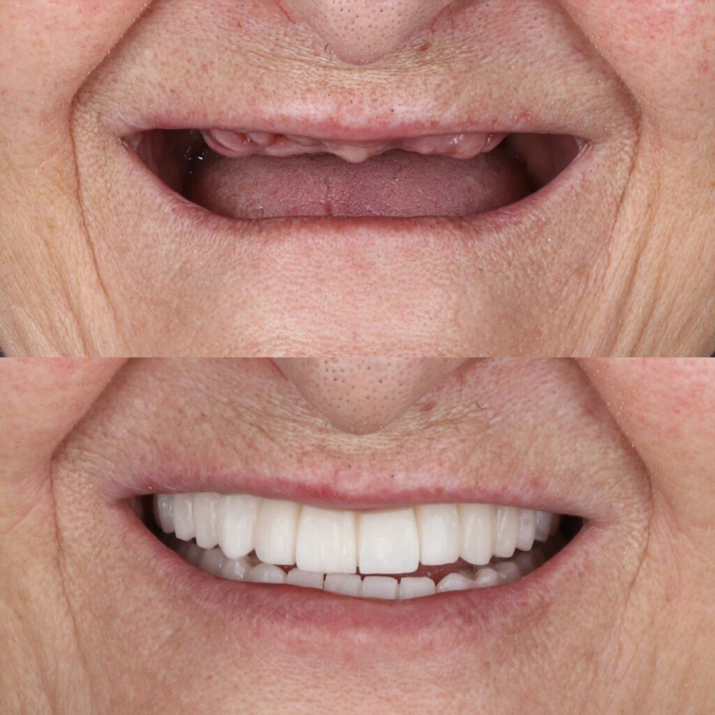 Full-arch denture prosthesis with dental implants placed in the jawbone. Full arch implant treatment with porcelain prosthesis