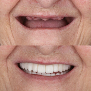 Full-arch denture prosthesis with dental implants placed in the jawbone. Full arch implant treatment with porcelain prosthesis